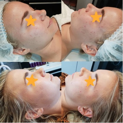 APOCALYPSIS ACNE